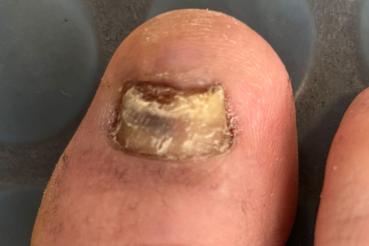 Ursachen und Behandlung von brüchigen Nägeln Symptome erkennen