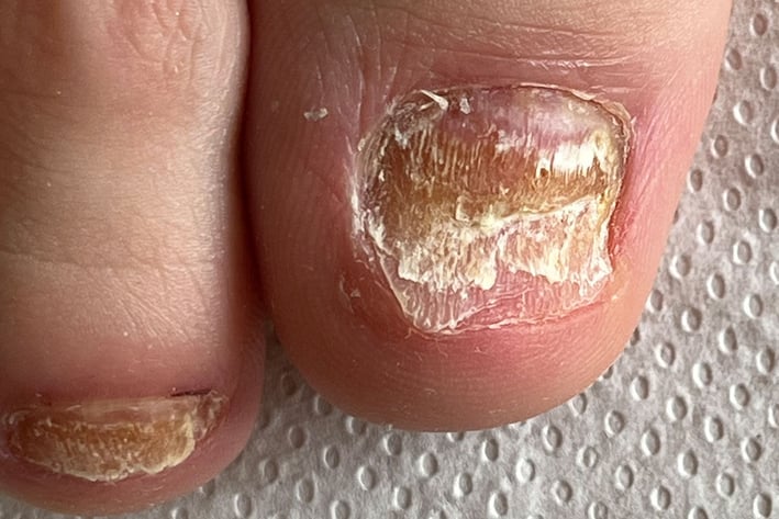 Verdickter, gelblich-brauner und bröckeliger Nagel am großen Zeh, eine häufige Nagelveränderung bei Diabetes