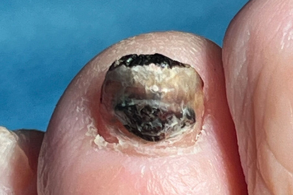 Zehennagel mit dunkelbraun bis schwarz verfärbter Nagelplatte durch einen Bluterguss unter dem Nagel
