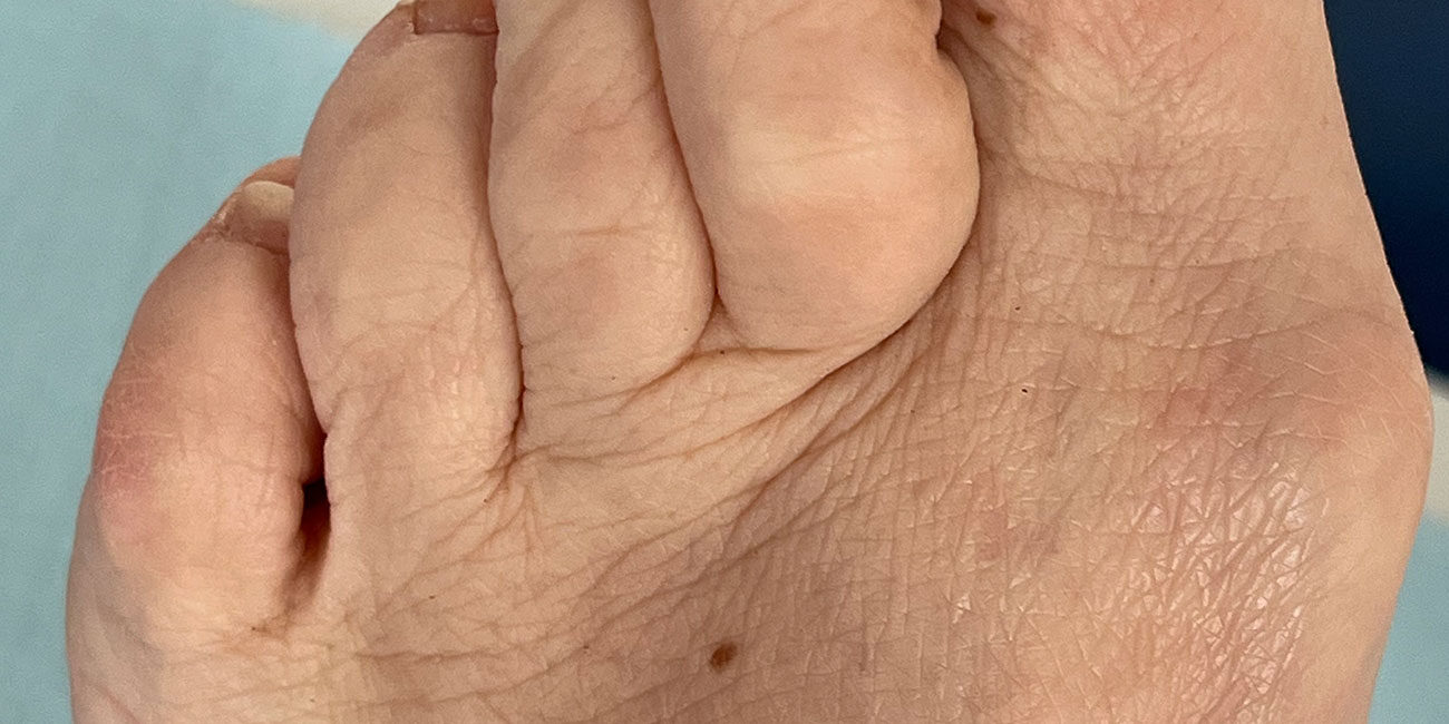 Ein linker Fuß mit Hallux Valgus