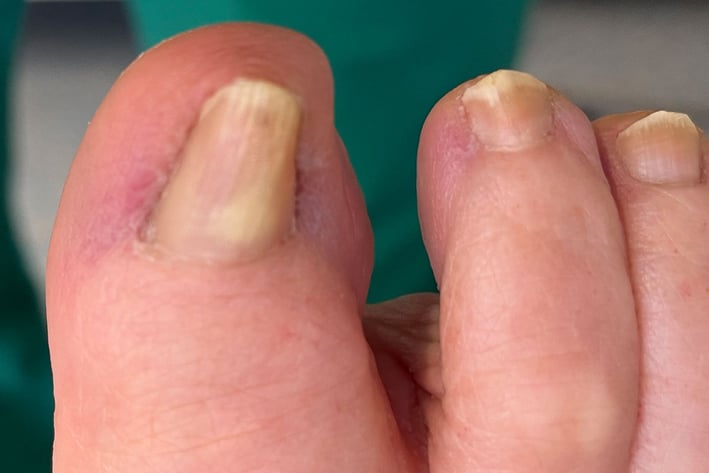 Krallennagel am großen Zeh: verdickte, gelbliche und längs gerillte Nagelplatte, auch die Nachbarnägel sind verdickt