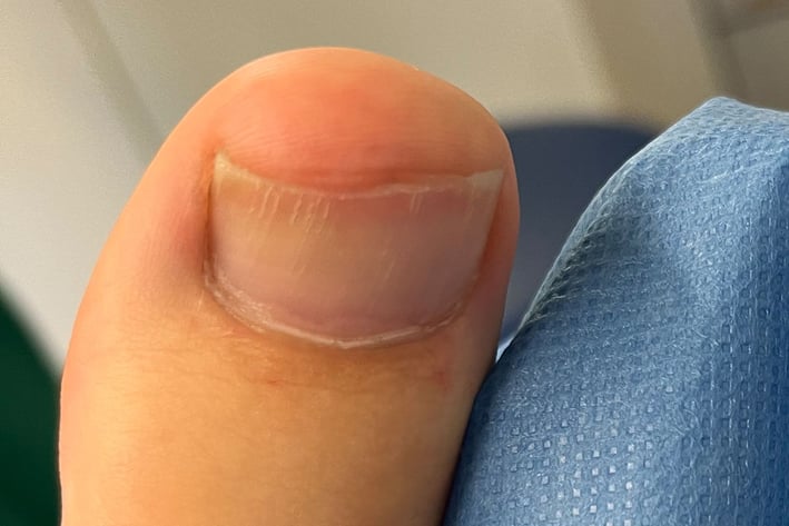 Großer Zeh mit kurzem, gerade geschnittenem Zehennagel neben einer blauen Abdeckung
