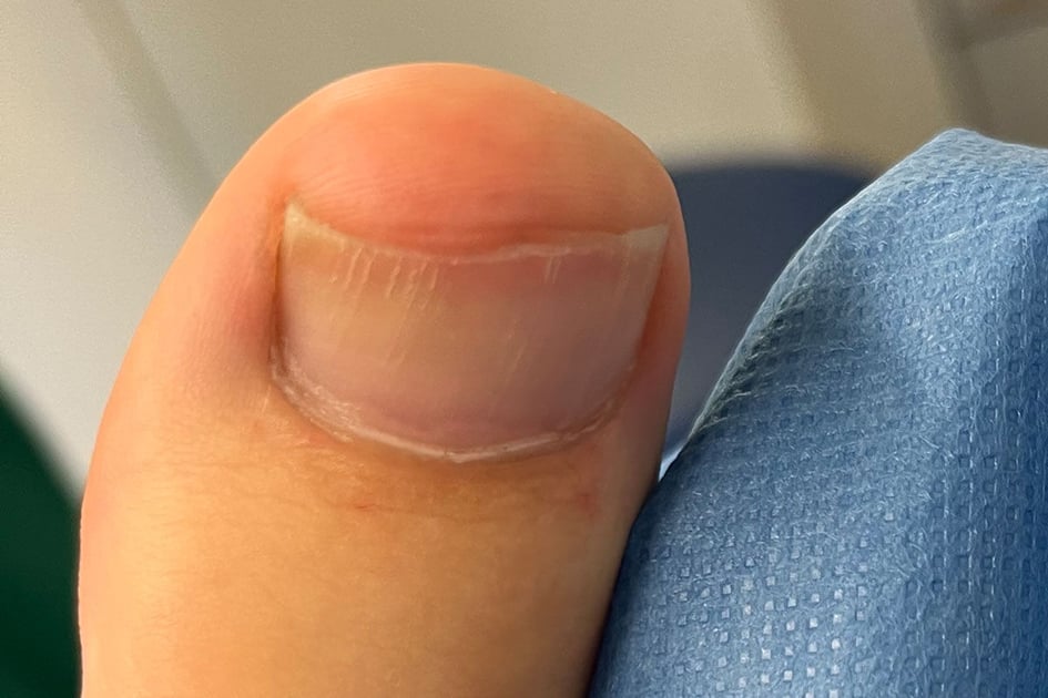 Großer Zeh mit kurzem, gerade geschnittenem Zehennagel neben einer blauen Abdeckung