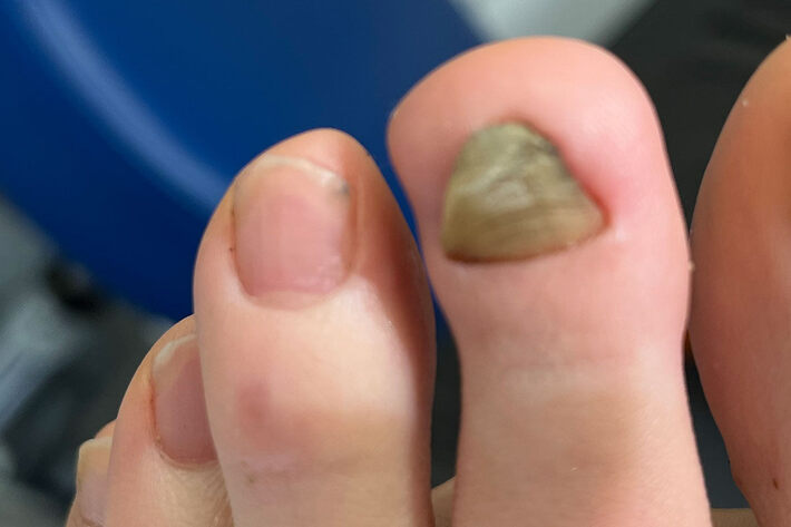 Verdickter Zehennagel mit gelblich-olivfarbener Nagelplatte, daneben der unauffällige Nagel der Nachbarzehe