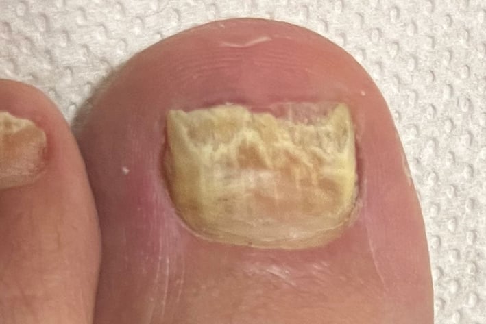 Nagelpilz am großen Zeh: gelb verfärbter, verdickter und bröckeliger Nagel, auch der Nachbarnagel ist verändert