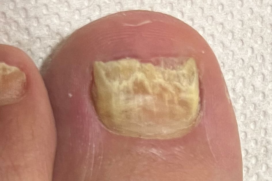 Nagelpilz am großen Zeh: gelb verfärbter, verdickter und bröckeliger Nagel, auch der Nachbarnagel ist verändert