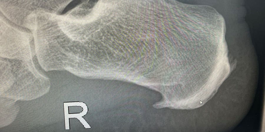 Seitliches Röntgenbild der rechten Ferse mit dem Fersenbein, an dessen Unterseite die Plantarfaszie ansetzt