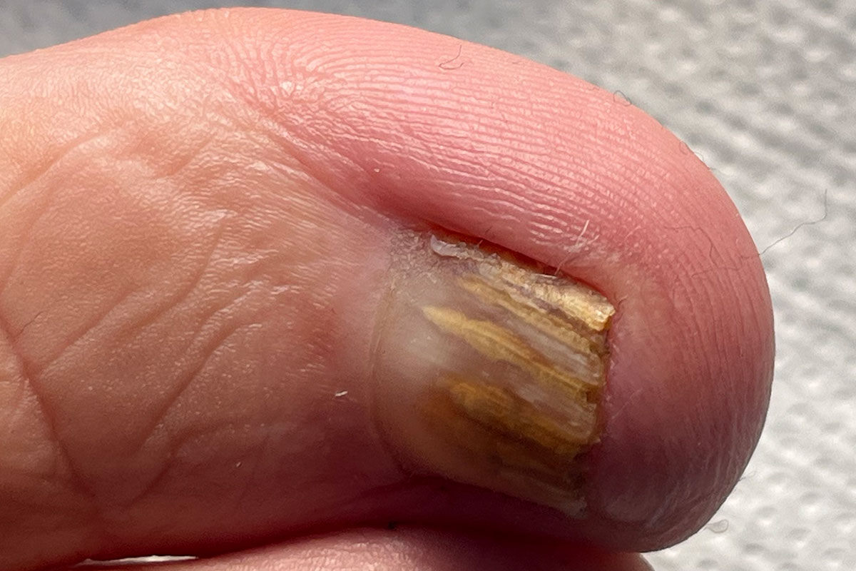 Ursachen und Lösungen für verfärbte Nägel: Behandlung und Prävention