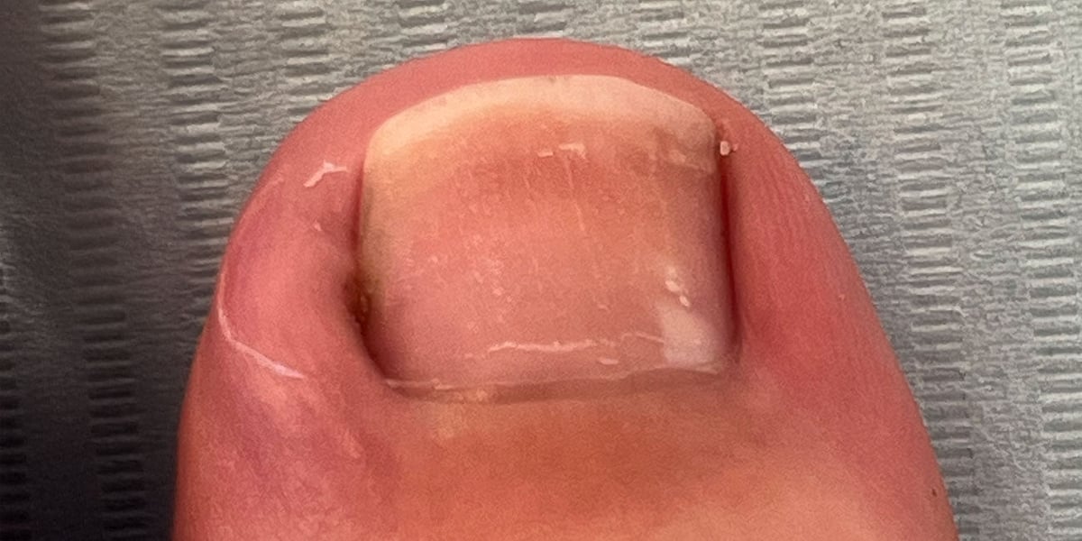 Großer Zeh mit leicht gerötetem seitlichem Nagelwall, wie bei einem beginnenden eingewachsenen Zehennagel
