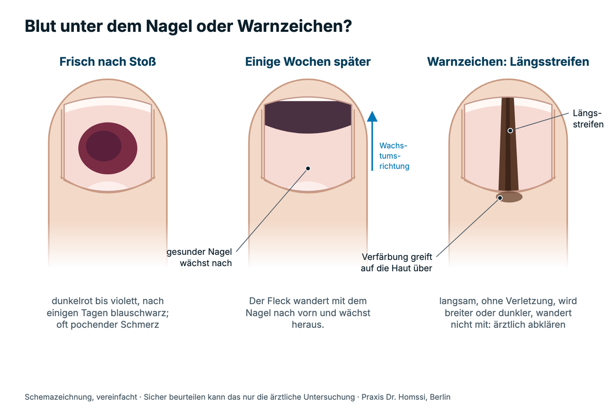 Schemazeichnung: frischer Bluterguss unter dem Nagel, herauswachsender Bluterguss und Längsstreifen als Warnzeichen