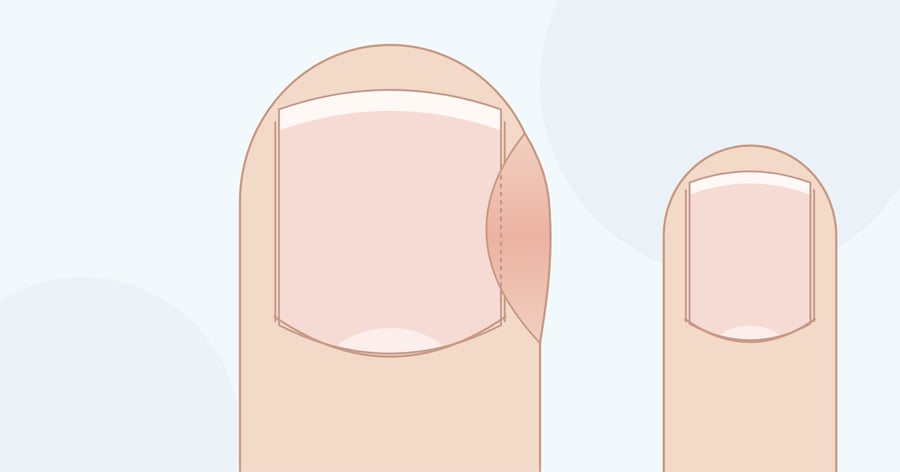 Zeichnung: Daumen von oben, die seitliche Nagelkante drückt in den geröteten, geschwollenen Nagelwall; daneben ein unauffälliger Finger