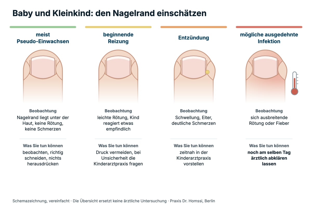 Schemazeichnung in vier Stufen am großen Zeh eines Babys: Pseudo-Einwachsen ohne Rötung, beginnende Reizung mit leichter Rötung, Entzündung mit Schwellung und gelblichem Punkt, sich ausbreitende Rötung mit Fieber; jeweils mit Beobachtung und dem nächsten Schritt