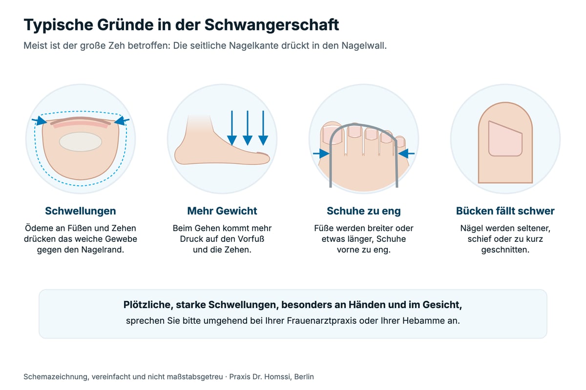 Schemazeichnung mit vier typischen Gründen in der Schwangerschaft: Schwellungen drücken das Gewebe gegen den Nagelrand, mehr Druck auf Vorfuß und Zehen, vorne zu enge Schuhe, schief oder zu kurz geschnittene Nägel; darunter ein Hinweis zu plötzlichen, starken Schwellungen