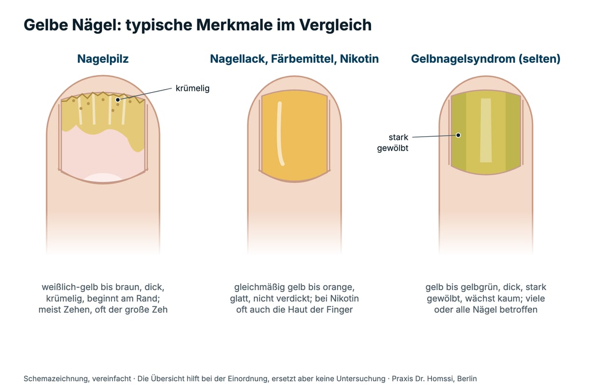 Schemazeichnung: gelbe Nägel bei Nagelpilz, bei Nagellack oder Nikotin und beim Gelbnagelsyndrom im Vergleich