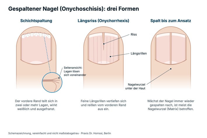 Schemazeichnung: drei Formen des gespaltenen Nagels, Schichtspaltung, Längsriss und Spalt bis zum Nagelansatz