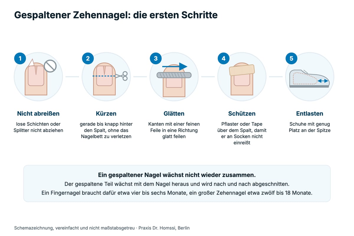 Anleitung in fünf Schritten bei einem gespaltenen Zehennagel: lose Schichten nicht abreißen, gerade bis knapp hinter den Spalt kürzen, Kanten in eine Richtung glatt feilen, Spalt mit Pflaster oder Tape schützen, Schuhe mit Platz an der Spitze tragen