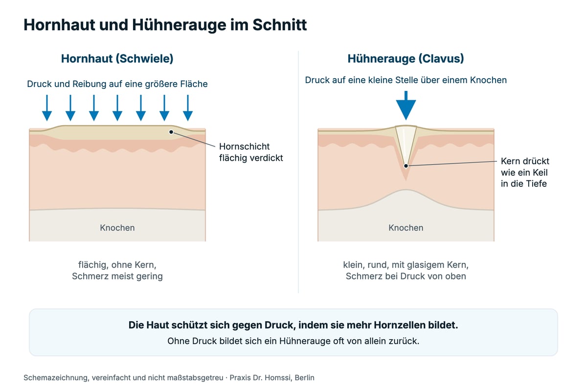 Schemazeichnung: Hornhaut und Hühnerauge im Schnitt. Bei Hornhaut ist die Hornschicht flächig verdickt, beim Hühnerauge drückt ein Kern über einem Knochen wie ein Keil in die Tiefe