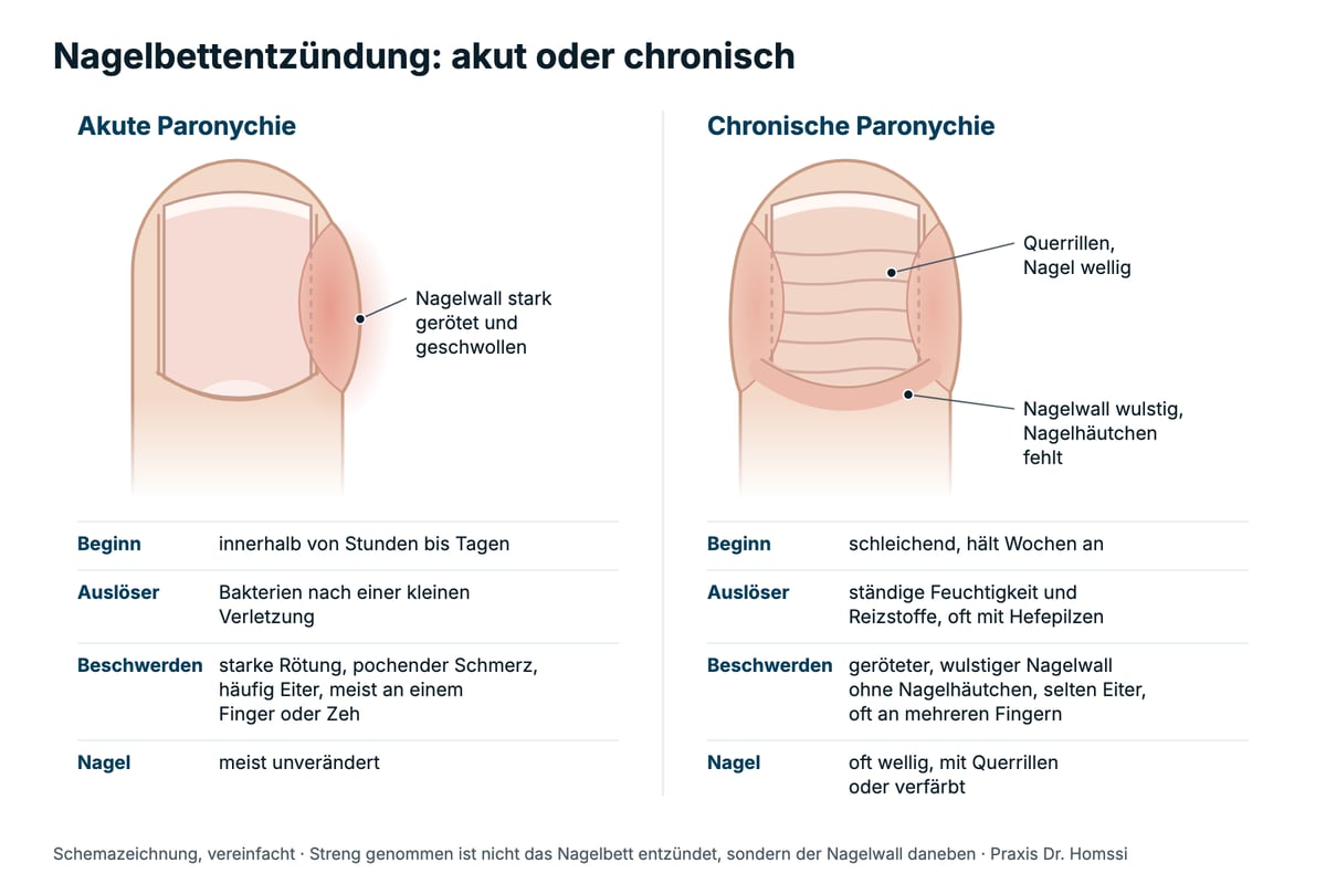 Schemazeichnung: akute und chronische Nagelbettentzündung im Vergleich, mit Beginn, Auslöser, Beschwerden und Veränderungen am Nagel