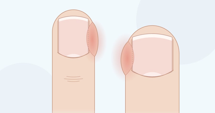 Zeichnung: Finger und großer Zeh, jeweils mit gerötetem, geschwollenem seitlichem Nagelwall