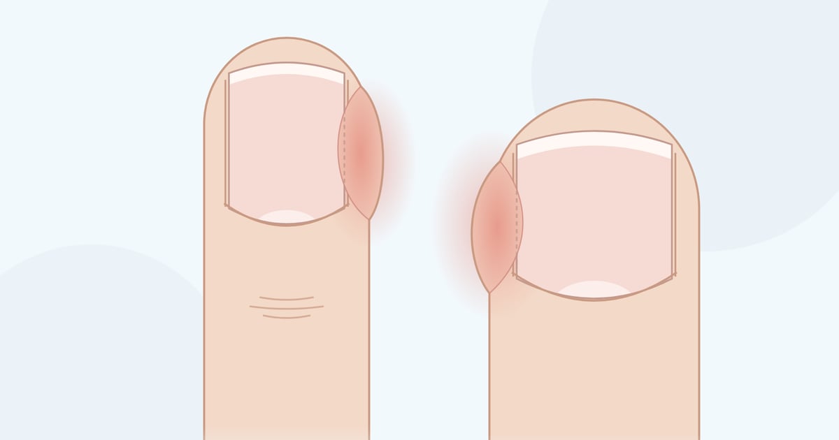 Zeichnung: Finger und großer Zeh, jeweils mit gerötetem, geschwollenem seitlichem Nagelwall