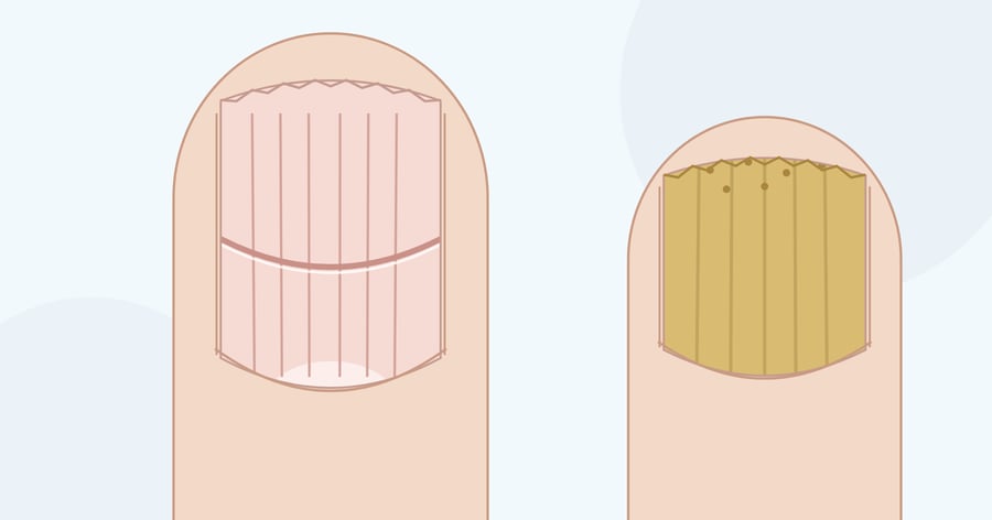 Zeichnung: Finger von oben mit gerilltem Nagel und ausgefranstem Rand, daneben ein großer Zeh mit dickem, gelblichem Nagel
