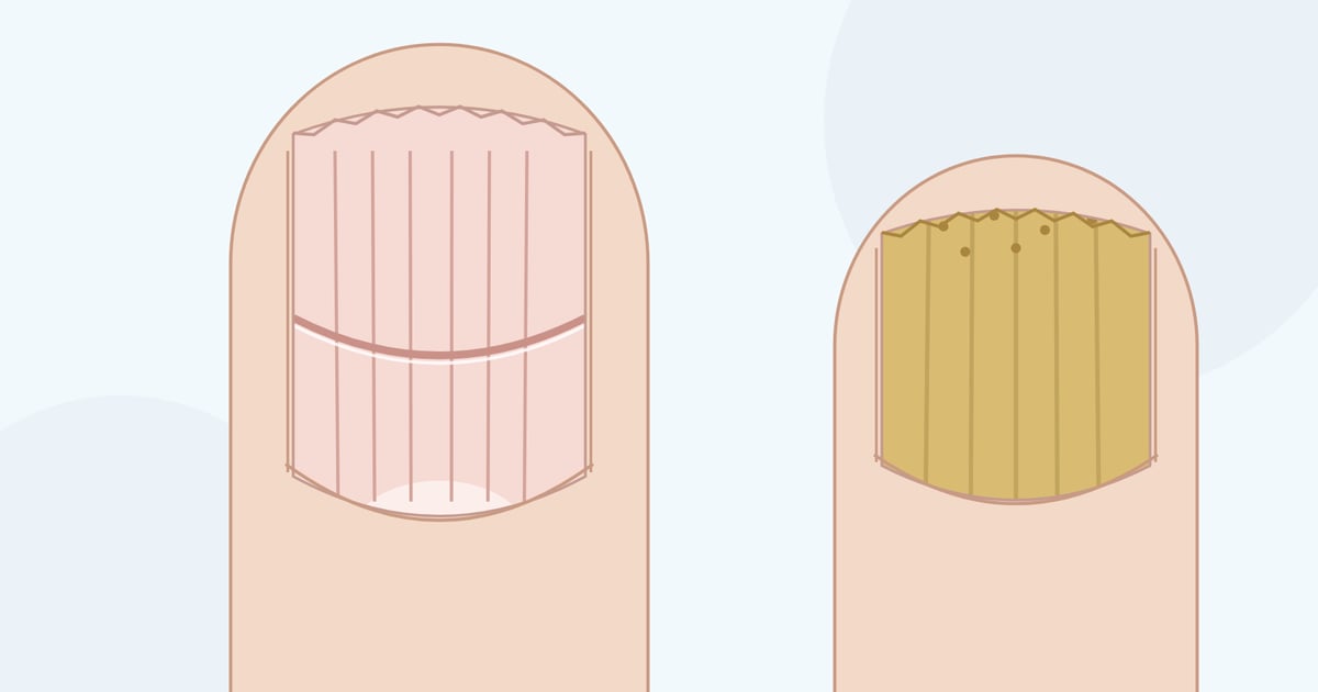 Zeichnung: Finger von oben mit gerilltem Nagel und ausgefranstem Rand, daneben ein großer Zeh mit dickem, gelblichem Nagel