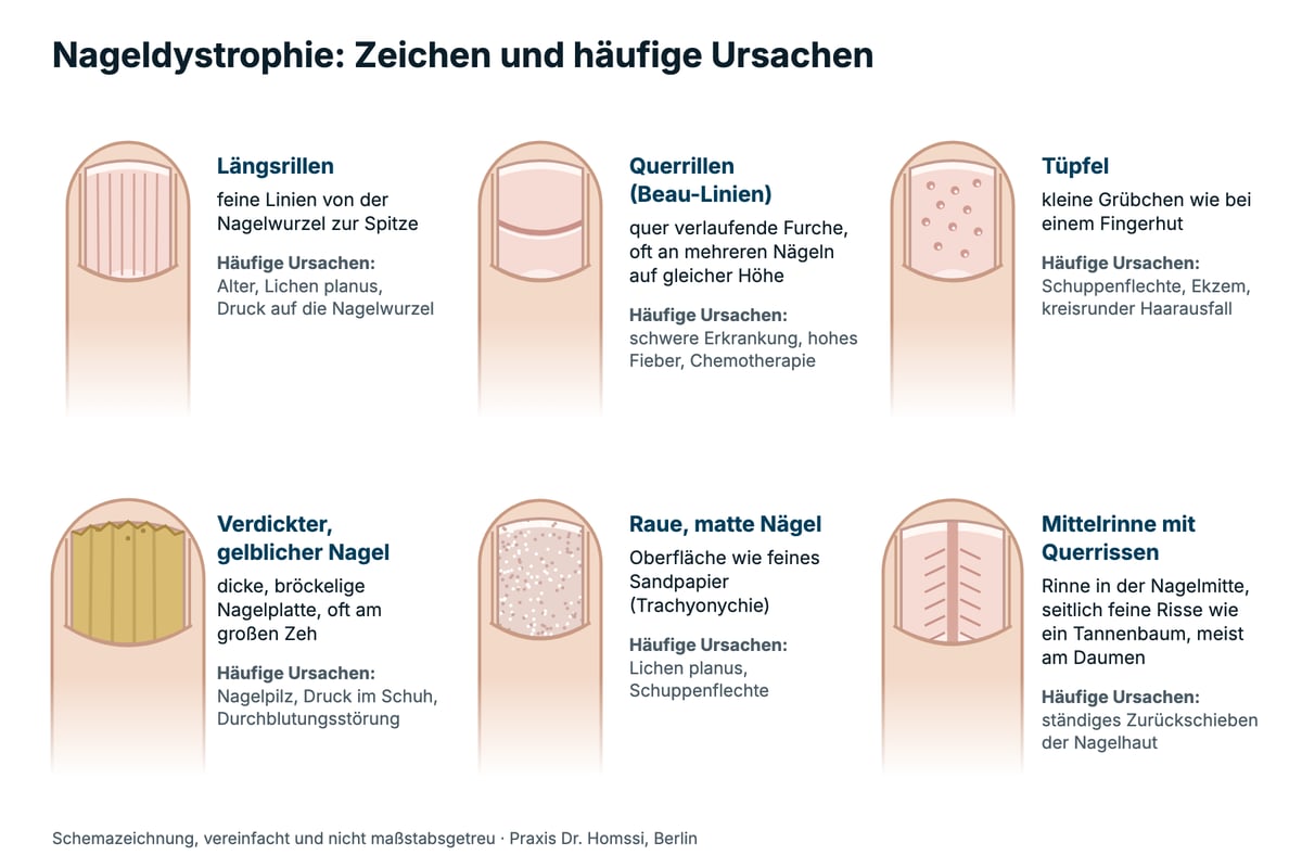 Schemazeichnung: sechs Zeichen einer Nageldystrophie mit häufigen Ursachen: Längsrillen, Querrillen, Tüpfel, verdickter gelblicher Nagel am großen Zeh, raue matte Nägel und Mittelrinne mit Querrissen am Daumen