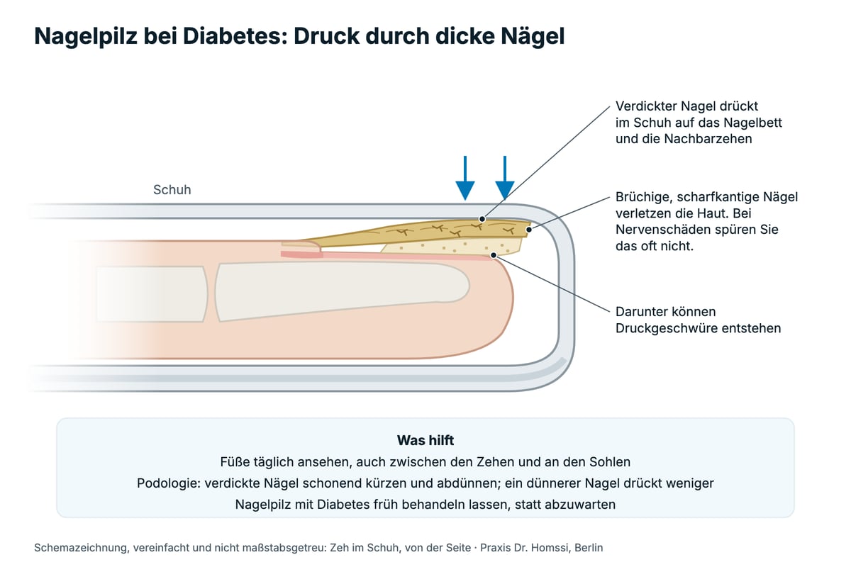 Schemazeichnung: Zeh mit verdicktem Pilznagel im Schuh von der Seite; das Oberleder drückt auf den Nagel und damit auf das Nagelbett