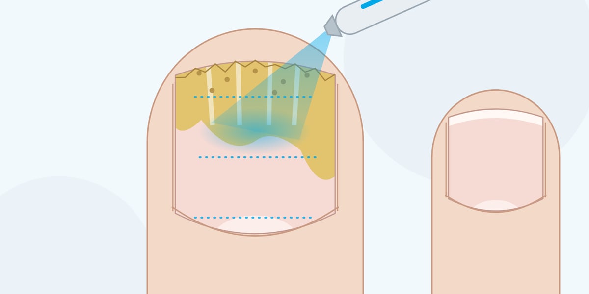 Drawing: laser treatment of a toenail with nail fungus