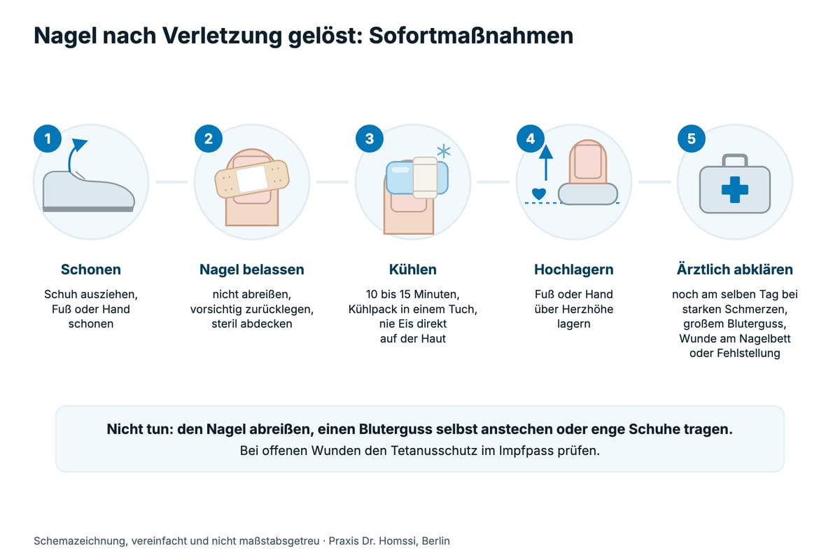 Anleitung in fünf Schritten nach einer Nagelverletzung: Schuh ausziehen und schonen, Nagel belassen und steril abdecken, 10 bis 15 Minuten kühlen, über Herzhöhe hochlagern, ärztlich abklären