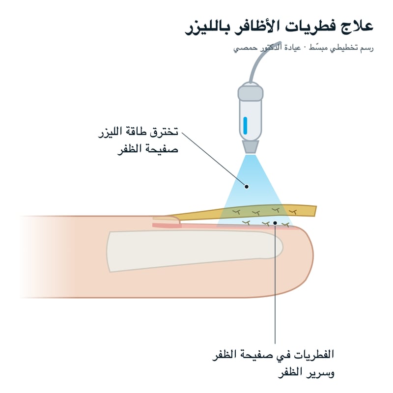 رسم تخطيطي: تخترق طاقة الليزر صفيحة الظفر، والفطريات في صفيحة الظفر وسرير الظفر