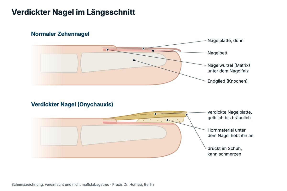 Schemazeichnung: normaler und verdickter Zehennagel (Onychauxis) im Längsschnitt mit Nagelplatte, Nagelbett und Hornmaterial