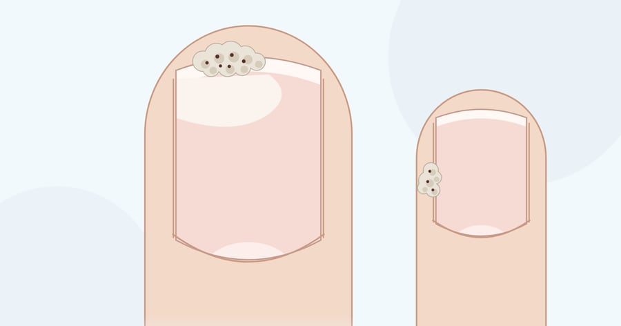 Zeichnung: Finger von oben mit rauer, grauweißer Warze unter dem vorderen Nagelrand, daneben ein Finger mit Warze am seitlichen Nagelrand