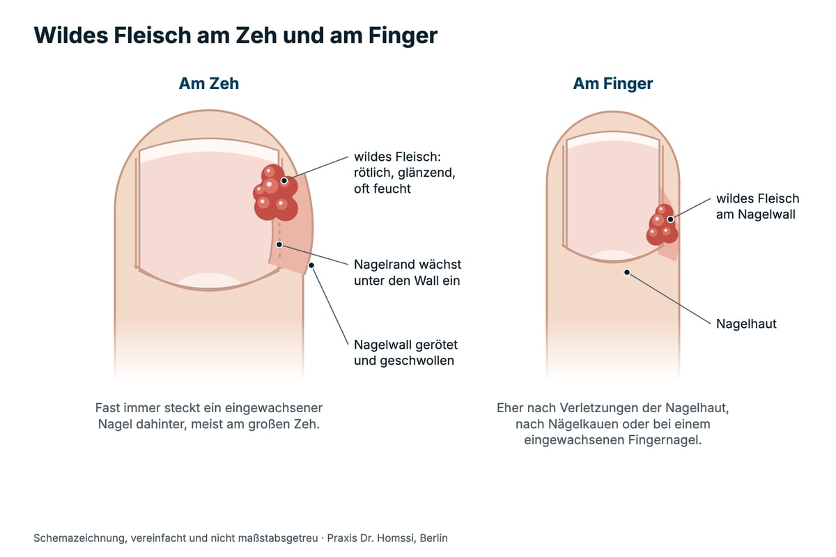 Schemazeichnung: wildes Fleisch am seitlichen Nagelwall von Zeh und Finger
