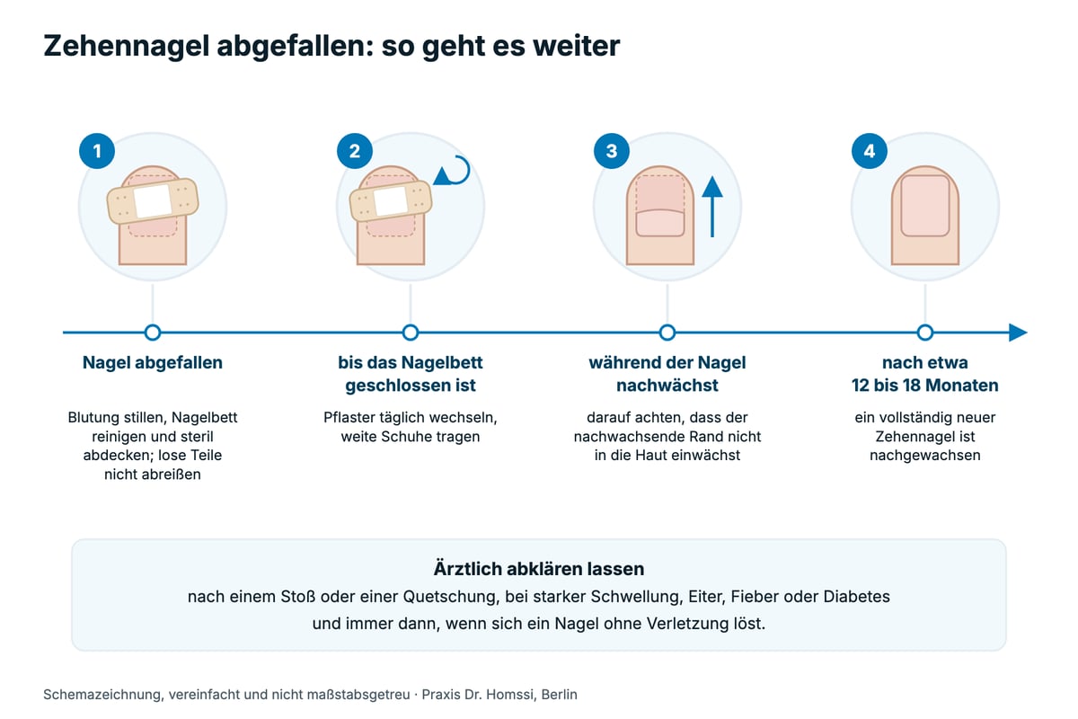 Schemazeichnung als Zeitstrahl: nach dem Nagelverlust das Nagelbett steril abdecken, Pflaster täglich wechseln, bis das Nagelbett geschlossen ist, beim Nachwachsen auf den Rand achten, nach etwa 12 bis 18 Monaten ist ein vollständig neuer Zehennagel nachgewachsen