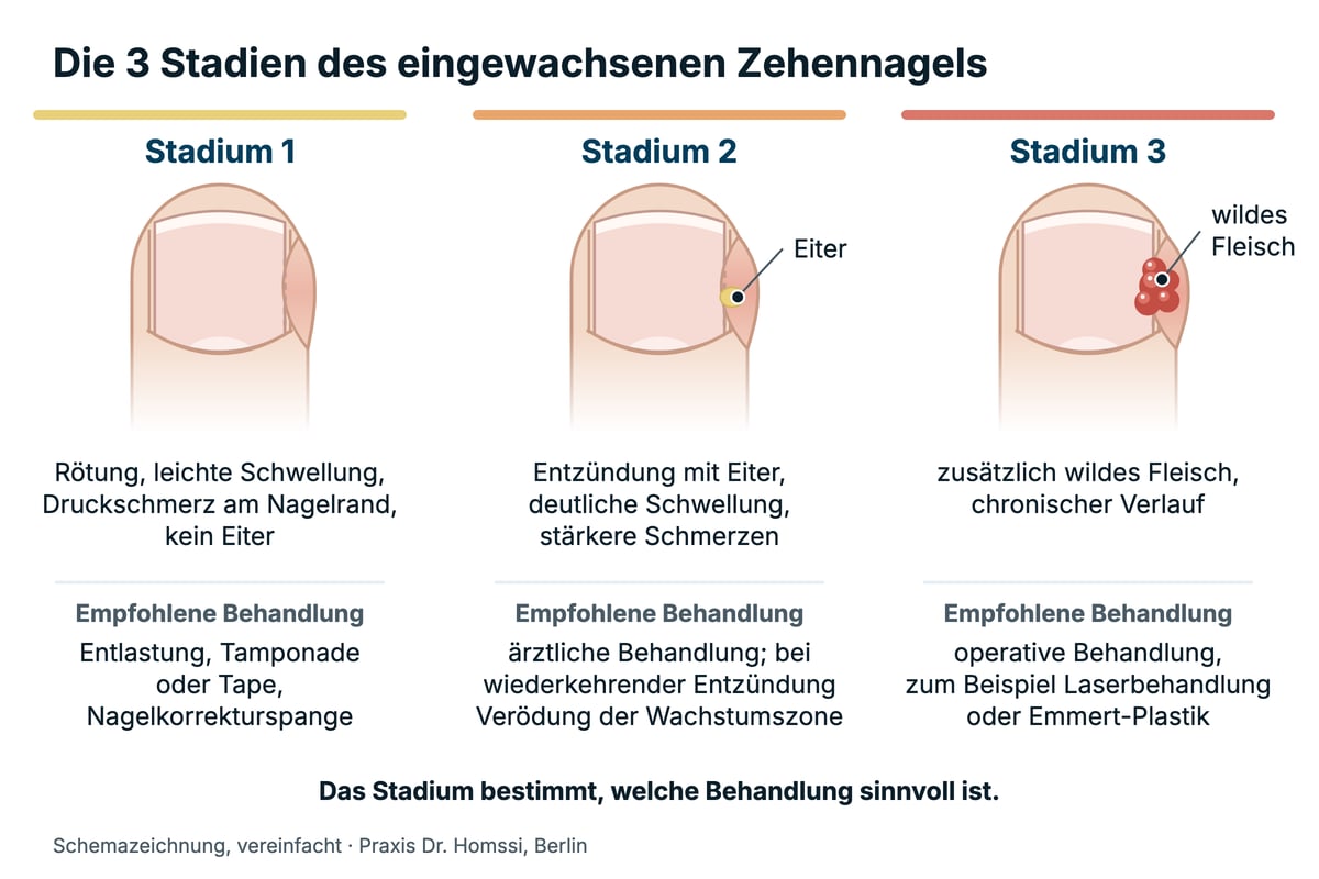 Schemazeichnung der drei Stadien des eingewachsenen Zehennagels: Rötung am Nagelwall, Eiter am Nagelrand und wildes Fleisch, jeweils mit der empfohlenen Behandlung.