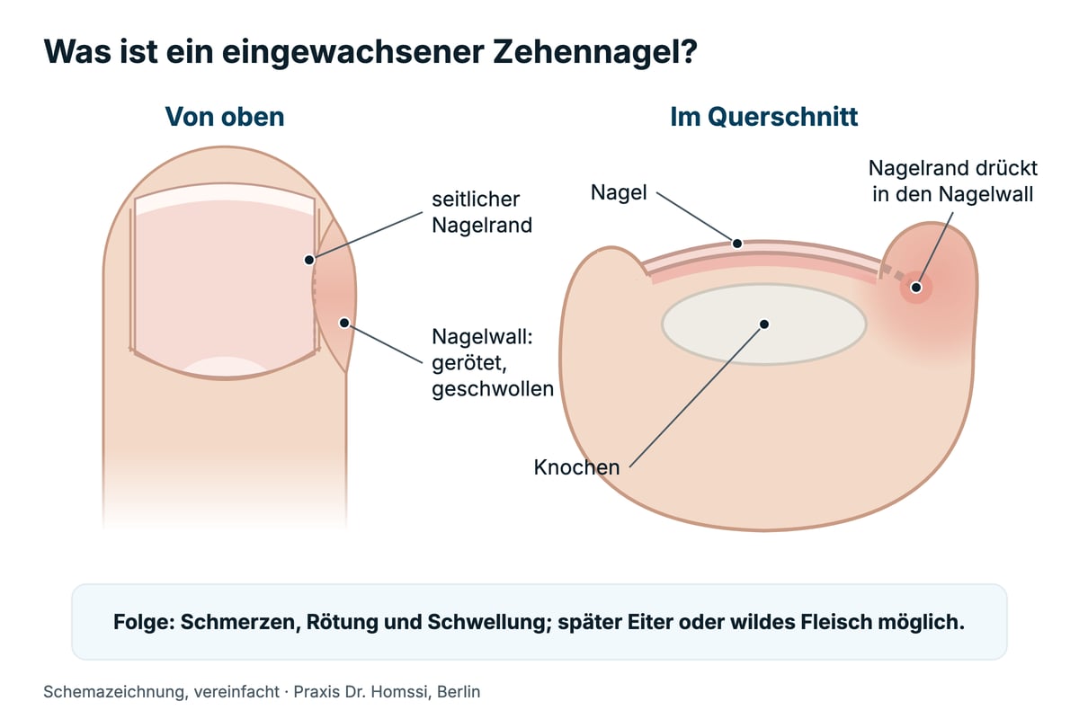 Schemazeichnung eingewachsener Zehennagel von oben und im Querschnitt: Der seitliche Nagelrand drückt in den geröteten, geschwollenen Nagelwall.