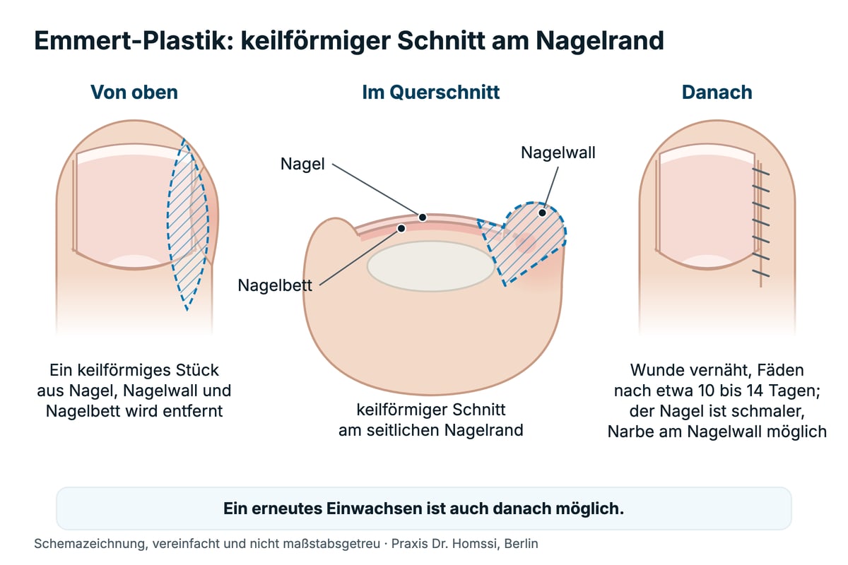Schemazeichnung Emmert-Plastik von oben und im Querschnitt: keilförmiger Schnitt am seitlichen Nagelrand durch Nagel, Nagelwall und Nagelbett.