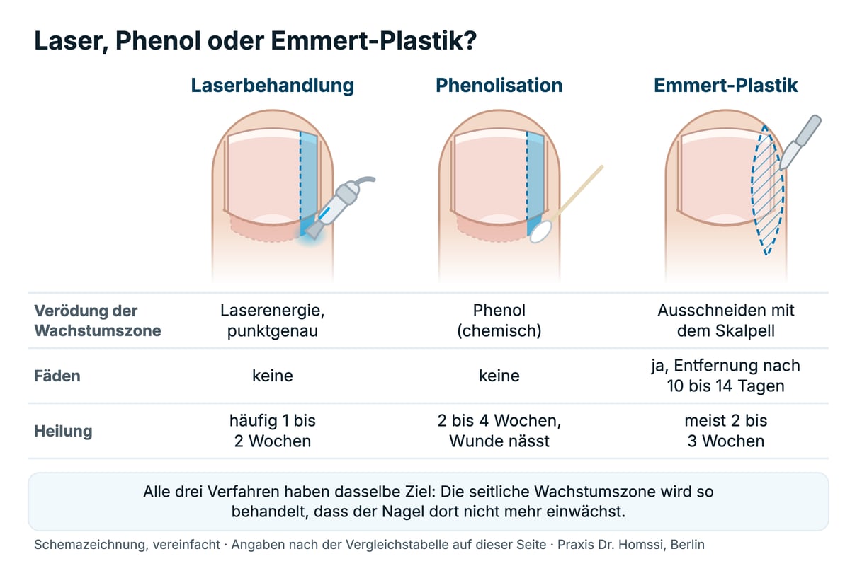 Schemazeichnung Laser, Phenol oder Emmert-Plastik beim eingewachsenen Zehennagel: wie die Wachstumszone behandelt wird, Fäden und Heilung im Vergleich.