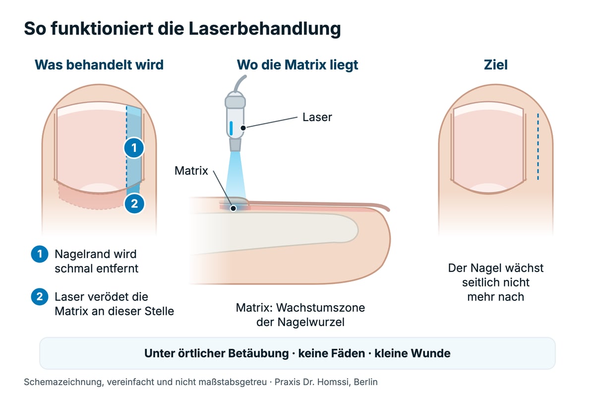 Schemazeichnung Laserbehandlung eingewachsener Zehennagel: Der Nagelrand wird schmal entfernt und der Laser verödet die Matrix an dieser Stelle.