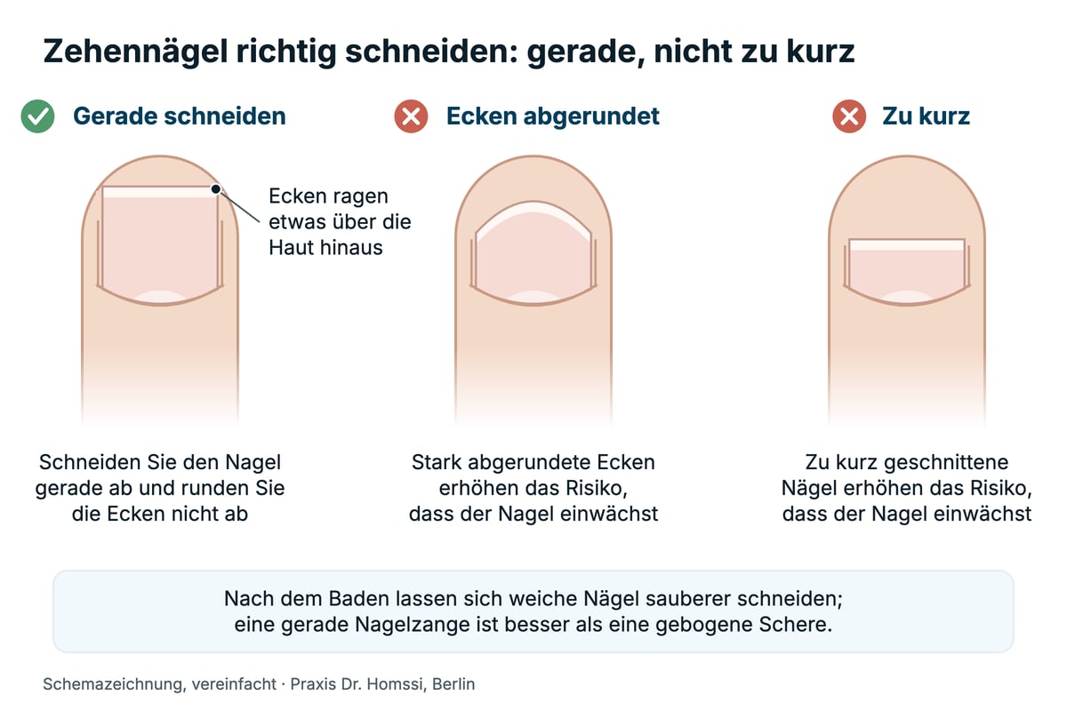 Schemazeichnung Zehennägel richtig schneiden gegen eingewachsene Zehennägel: gerade geschnittener Nagel im Vergleich zu abgerundeten Ecken und zu kurz geschnittenem Nagel.