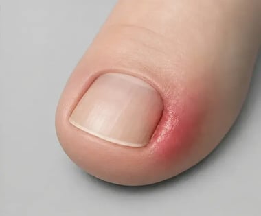 Zeh mit leichter Rötung am Nagelrand, Illustration