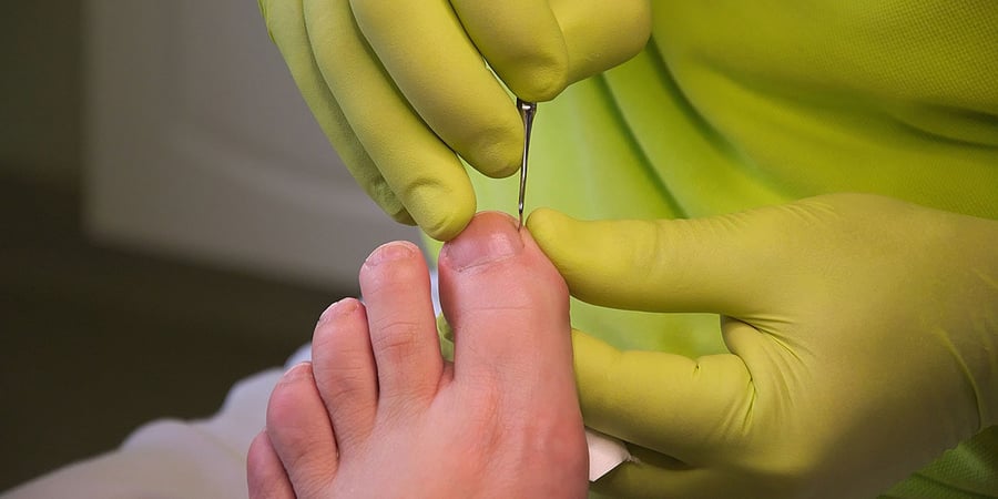 Fachgerechte Nagelpflege: Hände in grünen Handschuhen arbeiten mit einem feinen Instrument am Nagel des großen Zehs