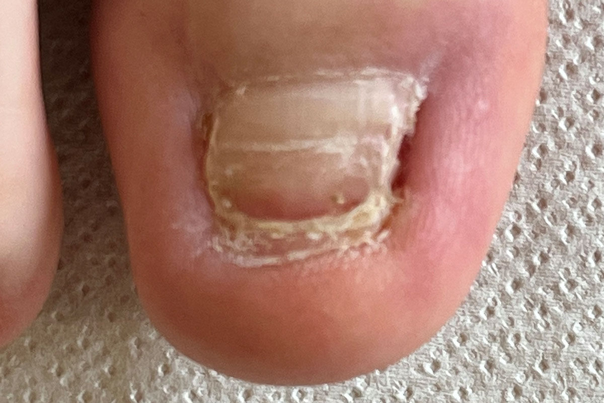 Nagel Ablösung vom Nagelbett (Onycholyse) Behandlung und Vorbeugung