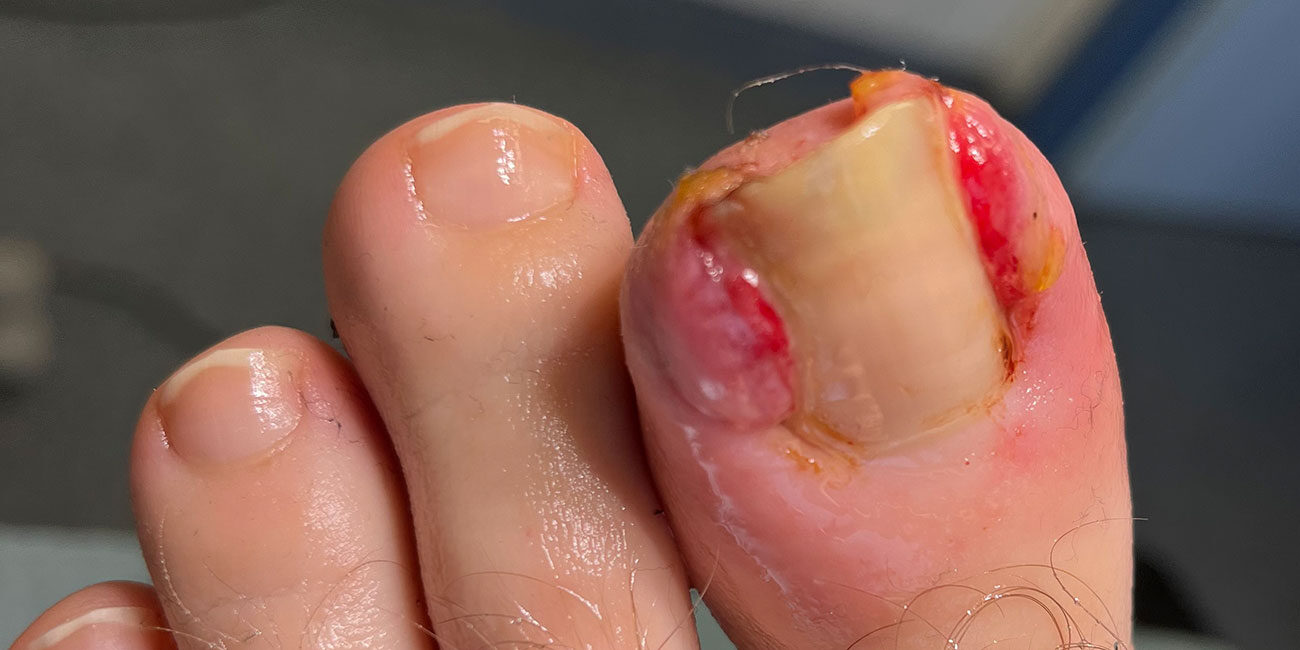 Schmerzhaftes wildes Fleisch an Nägeln: Effektive Entfernungsmethoden